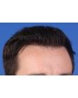 After Hair Transplant&nbsp;Hairlines
